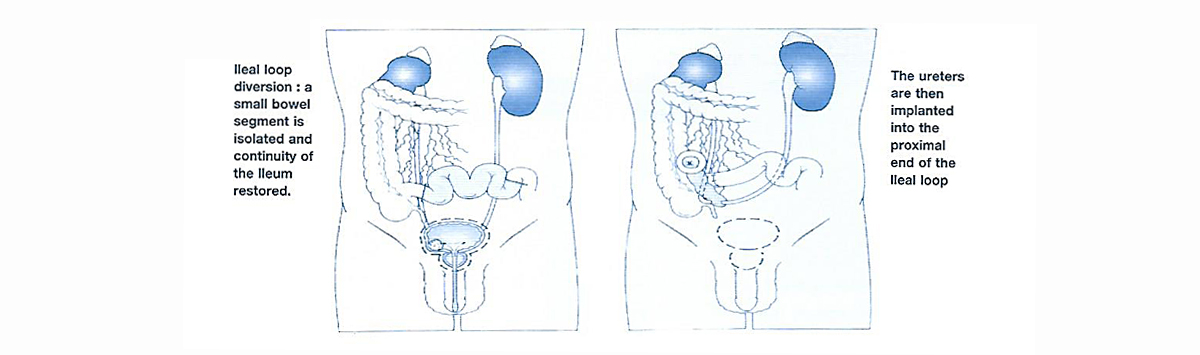 Urostomy Image